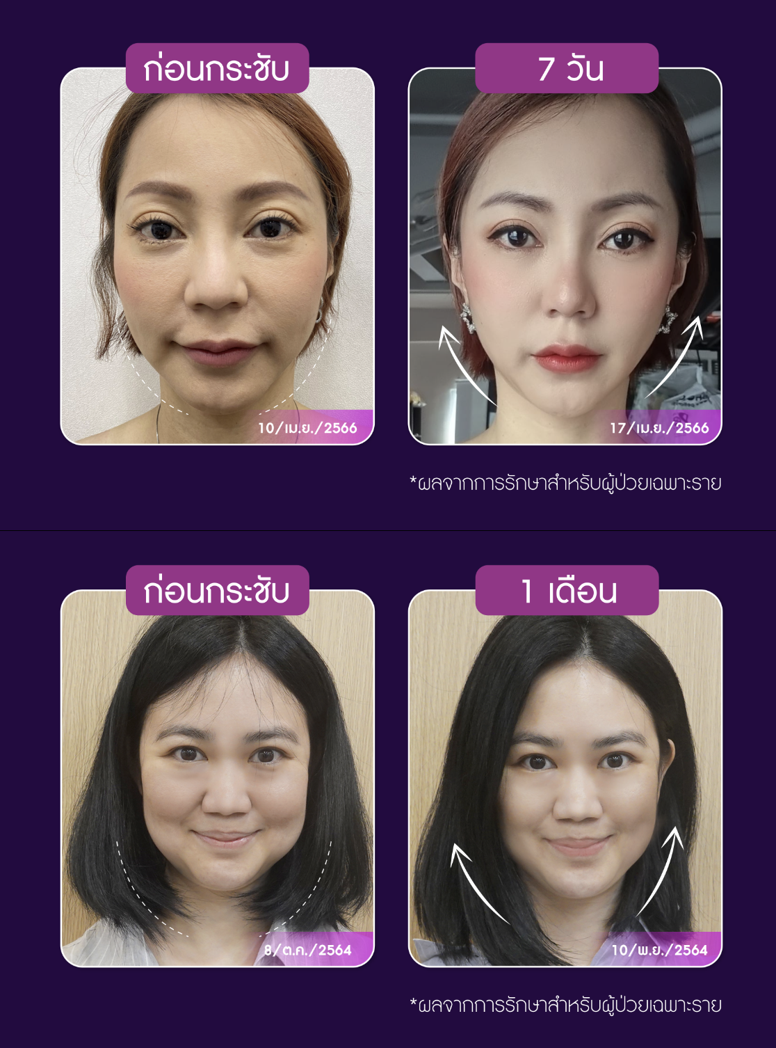 Thermage FLX 900 shots ราคา