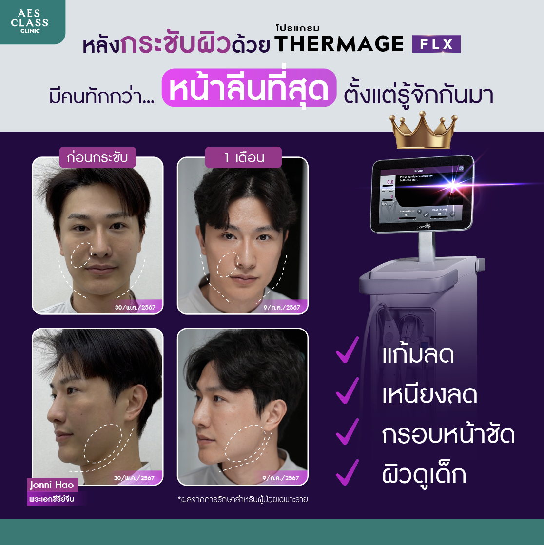 Thermage FLX 900 shots ราคา