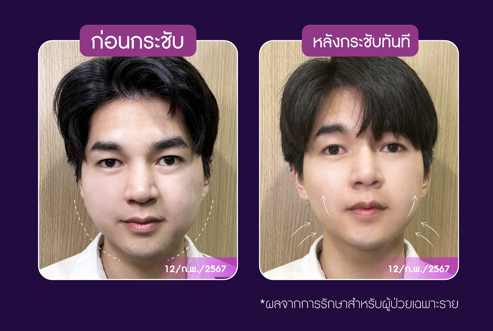 Thermage FLX 900 shots ราคา